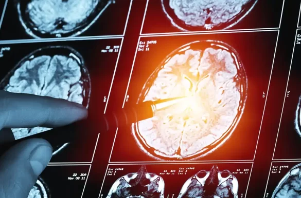 Kubital Sinir Tuzaklanması